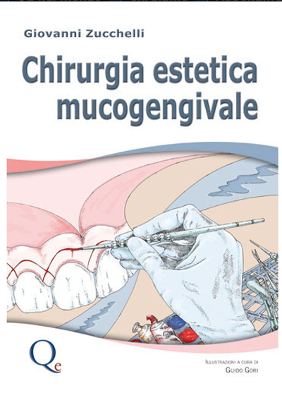 Chirurgia estetica mucogengivale